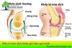 Tràn dịch khớp gối: Phương pháp điều trị và cách phòng ngừa